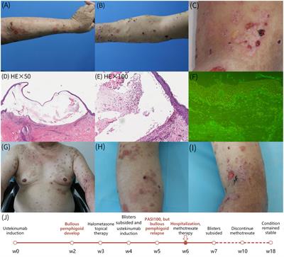 Development of bullous pemphigoid during treatment of psoriasis with ustekinumab: a case report and literature review